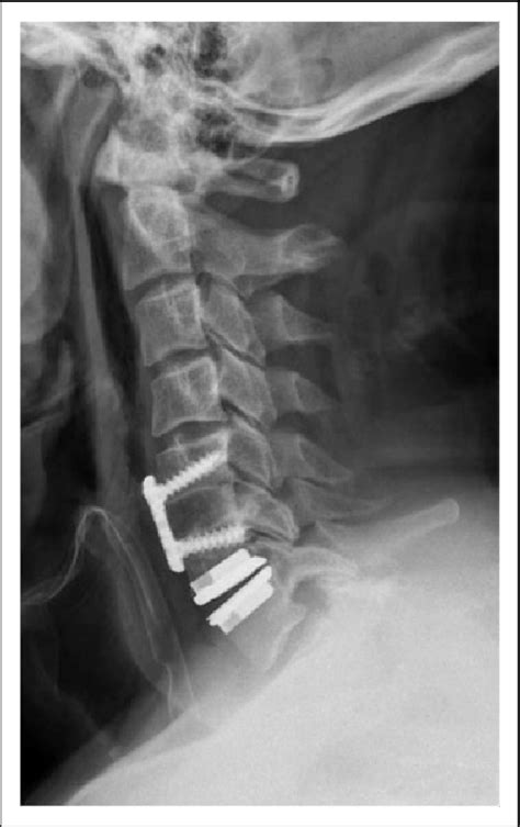 Anterior Cervical Disc Replacement Vs Discectomy Fusion Tw