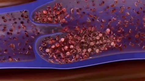 Тромбоэмболия - YouTube Картинка - Тромбоэмболия - YouTube