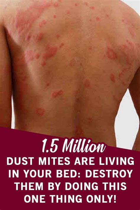 67 Amazing Mites Symptoms Humans Insectza