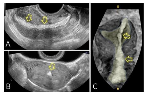 Diagnostics Free Full Text Uterine Perforation As A Complication Of