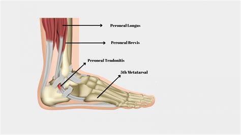 Best Exercises For Peroneal Tendonitis For Pain Relief