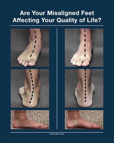 The Term Flat Foot Is A Generic And Mis Leading Description Given For