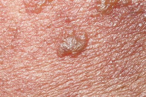 Shingles Rash On The Back Stock Image C0147986 Science Photo Library