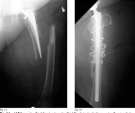 Figure 1 From Proximal Femoral Allograft Treatment Of Vancouver Type B3