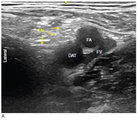 Ultrasound Guided Femoral Nerve Block Nysora The New York School Of