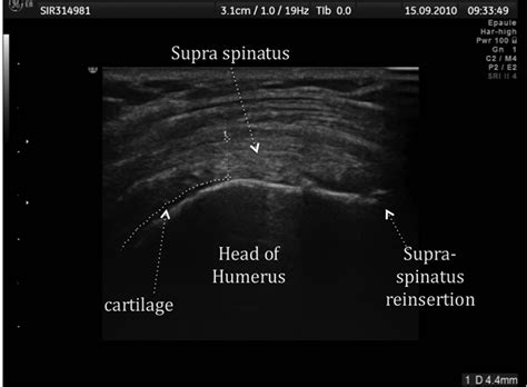 Supraspinatus Tendonitis Ultrasound Sexiz Pix
