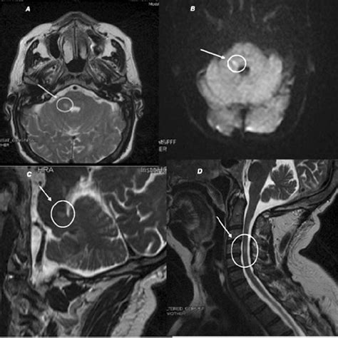 The Ct Showed A Heterogeneous Mass Located On The Right Tonsilar Area