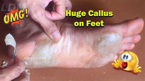 Callus Removal From Feet Youtube
