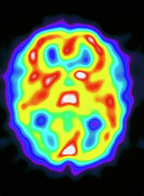Brain During Migraine Photograph by Dept. Of Nuclear ...