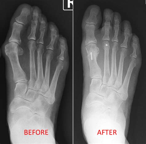 Bunion Treatment North Austin Foot And Ankle