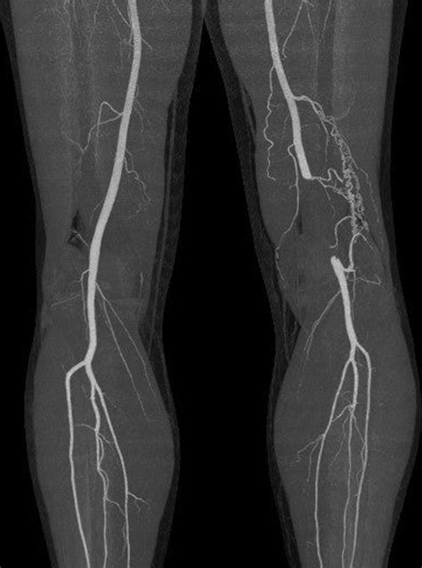 Claudication Without Risk Factors A Case Of Popliteal Entrapment