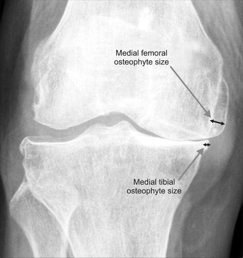 Measurement Of Medial Femoral Osteophyte Size And Medial Tibial