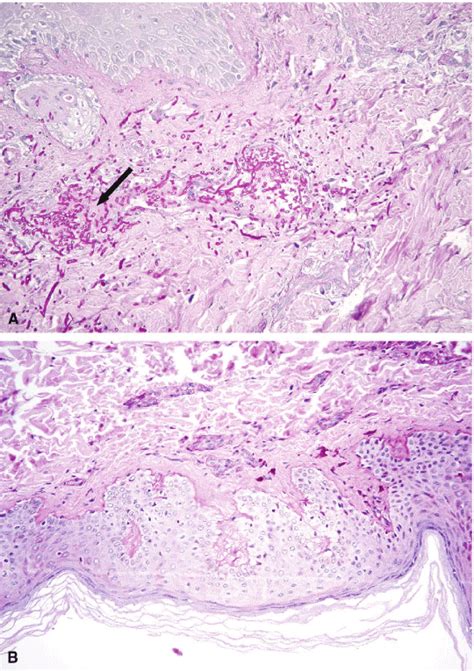 Biopsy Of Nodular Skin Lesion At The Diagnosis A And After Treatment