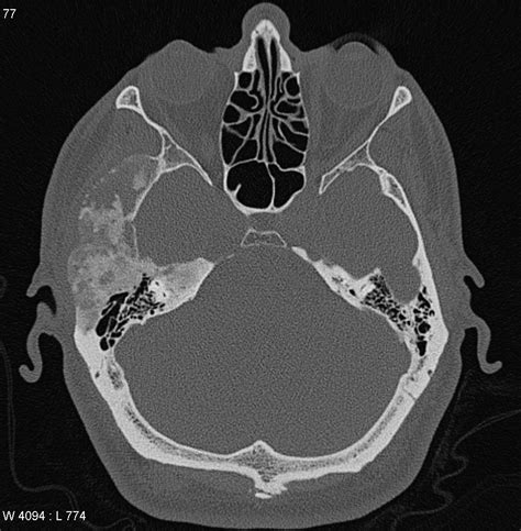 Fibrous Dysplasia Radiology Case
