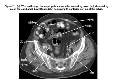 Lymphatics Of The Pelvis