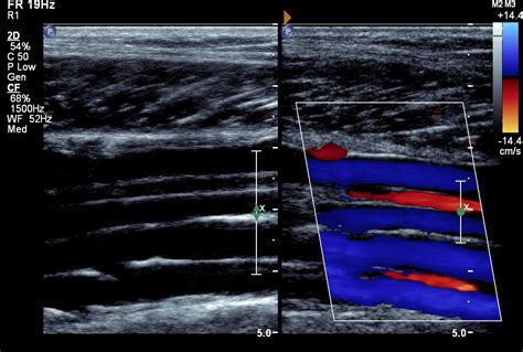 Leg Dvt Normal Ultrasoundpaedia Ultrasound Sonography Vascular Ultrasound Ultrasound