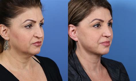 Beautiful Facelift Results In San Diego Ca By Dr John Hilinski