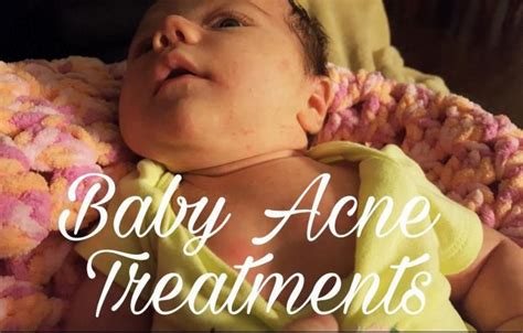 Baby Acne Treatments Baby Acne Baby Acne Treatment Acne Treatment