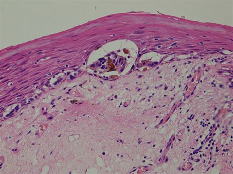 Head And Neck Primary Oral Mucosal Melanoma