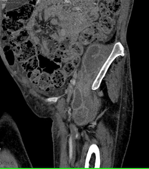 Left Iliopsoas Abscess With Extension To Left Hip Joint