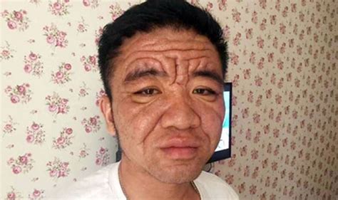 Bizarre Ageing Disease Makes 30 Year Old Look Like An Old Age Pensioner