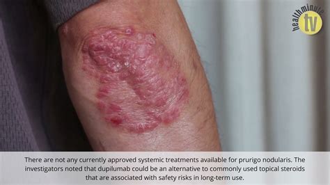 Dupilumab Linked To Reduced Itch In Prurigo Nodularis Patients