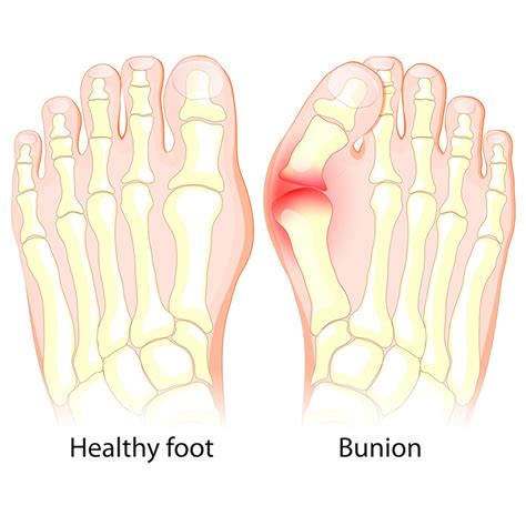 Bunions Signs And Symptoms Treatment Options In Chicago Il