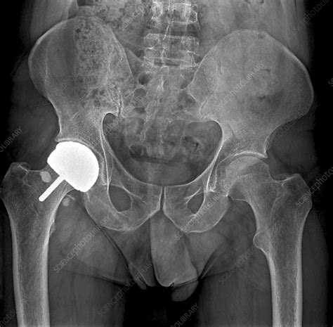 Hip Joint Resurfacing X Ray Stock Image C0337359 Science Photo