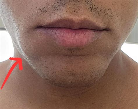 Woke Up With Swollen Lower Lip On One Side What Could Be The Cause