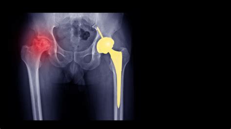 Things You Should Know About Hip Replacement Surgery Dr Mahesh Kulkarni