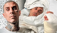 Travis Barker de Blink-182 tras cirugía en su dedo: "Fue un éxito ...