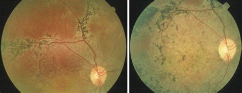 Natural Course Of Ocular Function In Pigmented Paravenous