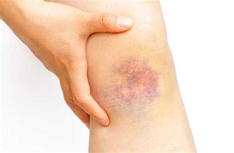 7 Reasons Why You Bruise Easily