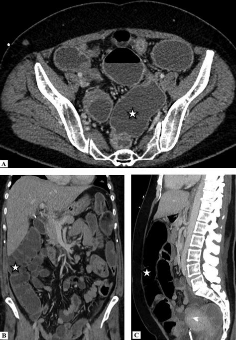 Contrast Enhanced Computed Tomography Cect Scan In The A Axial B