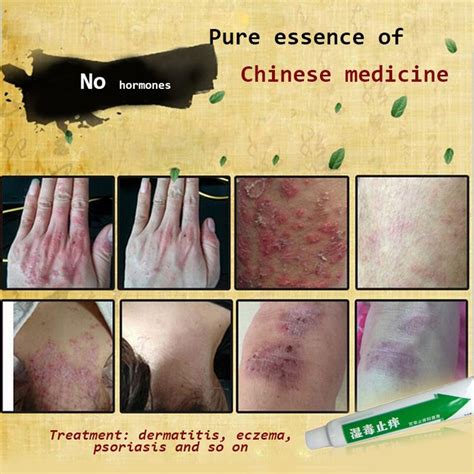 Acute And Chronic Itching Skin Itching And Allergic Dermatitis And