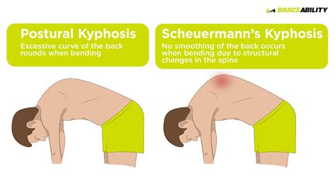 Scheuermanns Kyphosis Spineplus Scheuermann S Disease A 20 Year