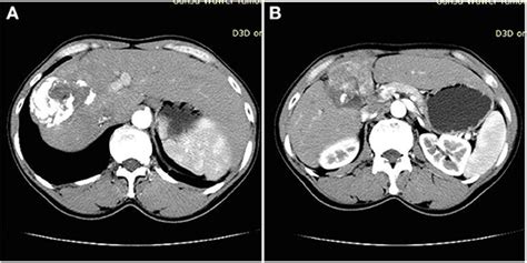 Frontiers Hepatocellular Carcinoma Complicated By Echinococcal Cyst