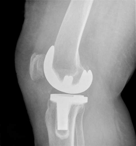 What Are The Causes Of Stiffness After Total Knee Replacement