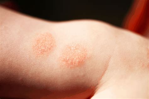 9 Early Signs Of Baby Eczema You Shouldnt Avoid