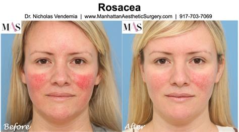 Before And After Ipl Treatments For Rosacea Rosacea Treatment Laser