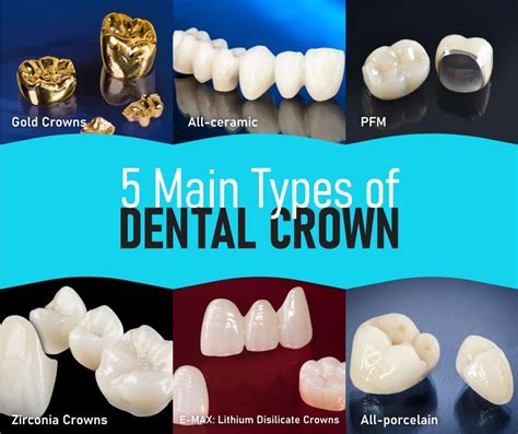 Different Types Of Dental Crowns My XXX Hot Girl