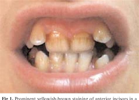 Doxycycline Induced Staining Of Permanent Adult Dentition Semantic
