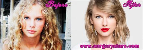 Taylor Swift Plastic Surgery Before And After Pictures
