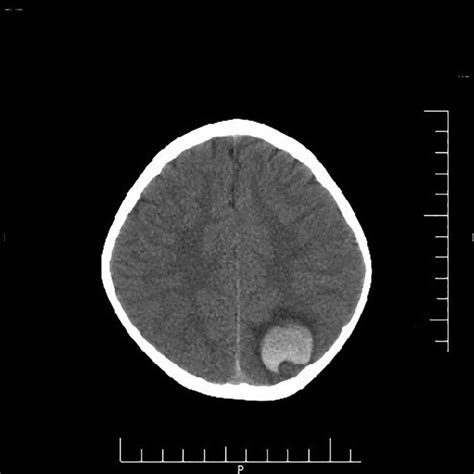 Axial Non Contrast Brain Computed Tomography Scan Showing Download
