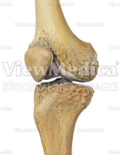 Viewmedica Stock Art Knee With Osteoarthritis Anteromedial View