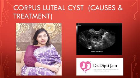 corpus luteal cyst causes and treatment youtube