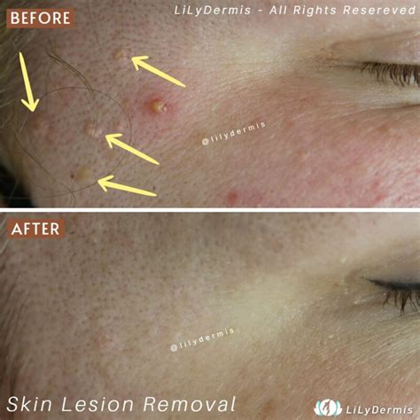 Sebaceous Hyperplasia Removal Lilydermis Calgary