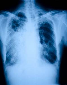 Lung Cancer Diagnosis - Net Health Book Lung Cancer  