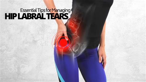 Essential Tips For Managing Your Hip Labral Tear Functional Before Form