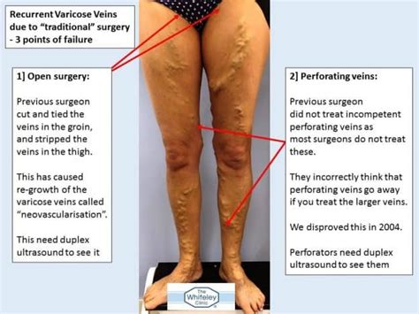 Recurrent Varicose Veins Due To Traditional Surgery The Whiteley Clinic